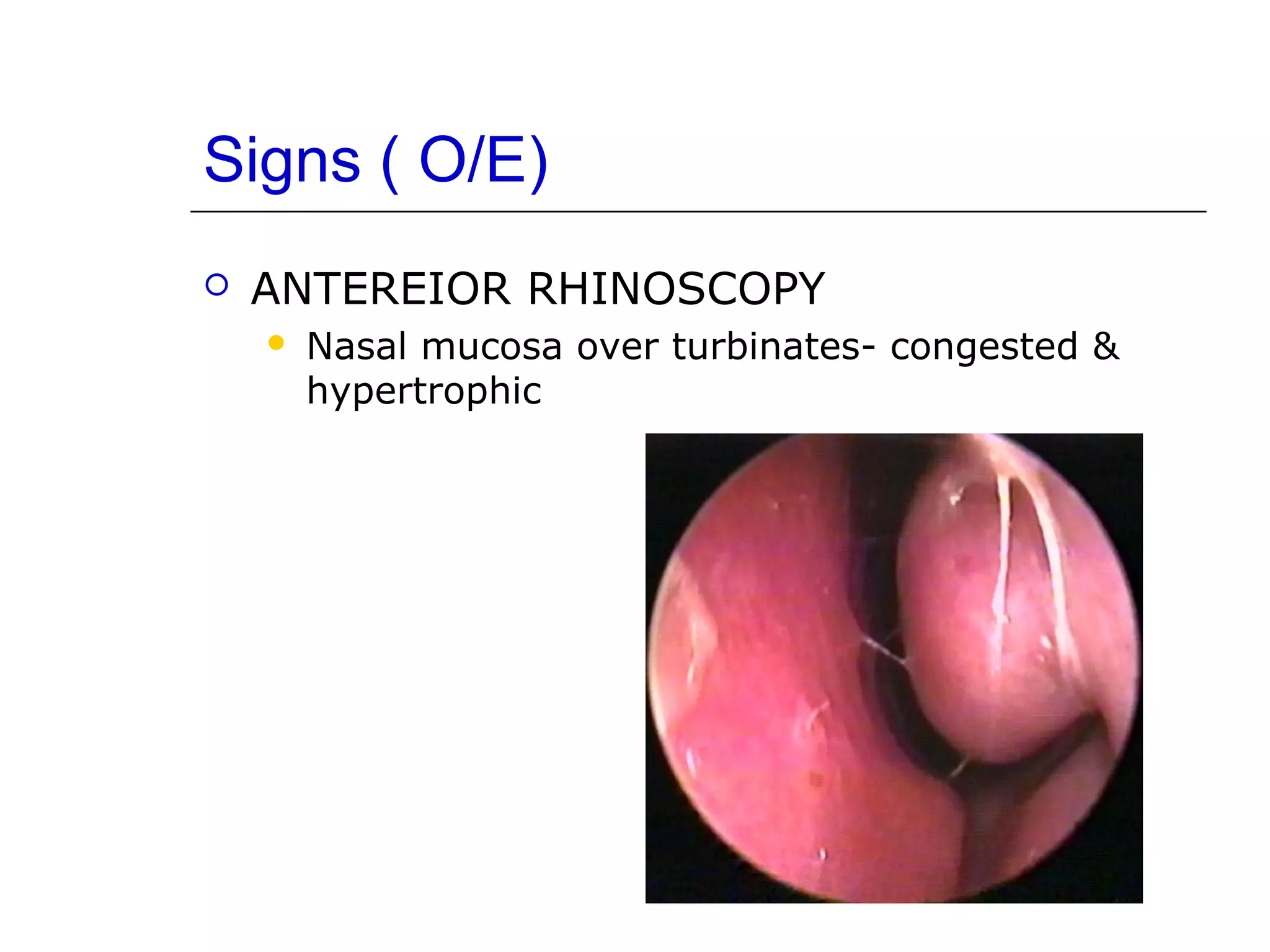 Vasomotor rhinitis & nares | PPT