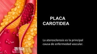 PLACA
CAROTIDEA
La aterosclerosis es la principal
causa de enfermedad vascular.
 