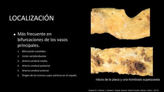 LOCALIZACIÓN
◼ Más frecuente en
bifurcaciones de los vasos
principales.
1. Bifurcación carotidea
2. Unión vertebrobasilar
3. Arteria cerebral media,
4. Arteria cerebral posterior
5. Arteria cerebral anterior
6. Origen de los troncos supra aórticos en el cayado.
Zwiebel WJ, Pellerito J. Zwiebel’s, Doppler General. Madrid España: Marban; 2008 p. 129-52.
rotura de la placa y una trombosis superpuesta
 