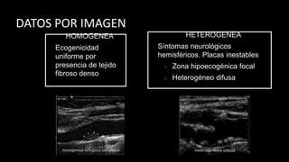 HOMOGENEA
Ecogenicidad
uniforme por
presencia de tejido
fibroso denso
HETEROGENEA
Síntomas neurológicos
hemisféricos. Placas inestables
1. Zona hipoecogénica focal
2. Heterogéneo difusa
DATOS POR IMAGEN
 