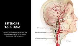 ESTENOSIS
CAROTIDEA
Disminución del lumen de un vaso que
condiciona alteración en el patrón
laminar del flujo sanguíneo.
 
