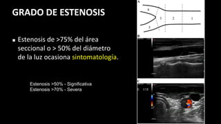 Estenosis >50% - Significativa
Estenosis >70% - Severa
GRADO DE ESTENOSIS
◼ Estenosis de >75% del área
seccional o > 50% del diámetro
de la luz ocasiona sintomatología.
 