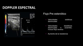 • Velocidades sistólicas
disminuidas
• Velocidades diastólicas
disminuidas o ausentes,
incluso flujo reverso
• Aumento de la resistencia
Flujo Pre estenótico
DOPPLER ESPECTRAL
 