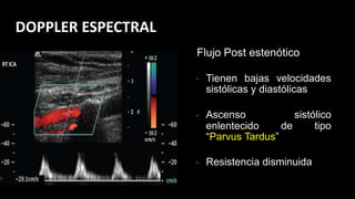 • Tienen bajas velocidades
sistólicas y diastólicas
• Ascenso sistólico
enlentecido de tipo
“Parvus Tardus”
• Resistencia disminuida
Flujo Post estenótico
DOPPLER ESPECTRAL
 