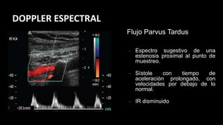 DOPPLER ESPECTRAL
• Espectro sugestivo de una
estenosis proximal al punto de
muestreo.
• Sístole con tiempo de
aceleración prolongado, con
velocidades por debajo de lo
normal.
• IR disminuido
Flujo Parvus Tardus
 