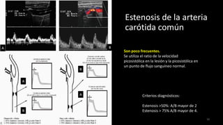 Estenosis de la arteria
carótida común
50
Criterios diagnósticos:
Estenosis >50%: A/B mayor de 2
Estenosis > 75% A/B mayor de 4.
Son poco frecuentes.
Se utiliza el ratio de la velocidad
picosistólica en la lesión y la picosistólica en
un punto de flujo sanguíneo normal.
 