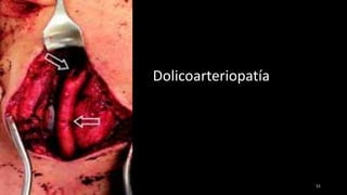 Dolicoarteriopatía
51
 