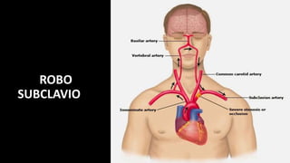 ROBO
SUBCLAVIO
 