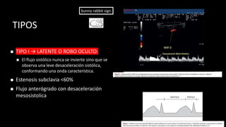 TIPOS
◼ TIPO I → LATENTE O ROBO OCULTO:
◼ El flujo sistólico nunca se invierte sino que se
observa una leve desaceleración sistólica,
conformando una onda característica.
◼ Estenosis subclavia <60%
◼ Flujo anterógrado con desaceleración
mesosistolica
bunny rabbit sign
 