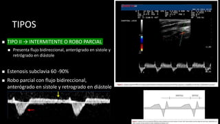 TIPOS
◼ TIPO II → INTERMITENTE O ROBO PARCIAL
◼ Presenta flujo bidireccional, anterógrado en sístole y
retrógrado en diástole
◼ Estenosis subclavia 60 -90%
◼ Robo parcial con flujo bidireccional,
anterógrado en sístole y retrogrado en diástole
 