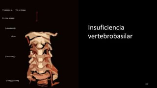 Insuficiencia
vertebrobasilar
63
 