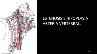 ESTENOSIS E HIPOPLASIA
ARTERIA VERTEBRAL.
67
 