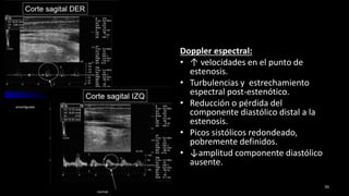 Doppler espectral:
• ↑ velocidades en el punto de
estenosis.
• Turbulencias y estrechamiento
espectral post-estenótico.
• Reducción o pérdida del
componente diastólico distal a la
estenosis.
• Picos sistólicos redondeado,
pobremente definidos.
• ↓amplitud componente diastólico
ausente.
70
amortiguada
normal
 