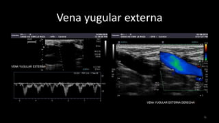 Vena yugular externa
76
 