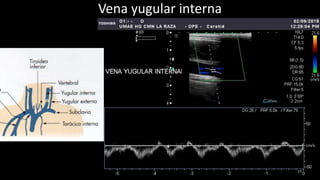 Vena yugular interna
77
 