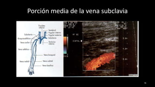 Porción media de la vena subclavia
78
 