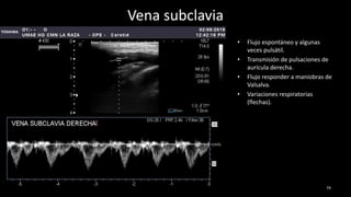 Vena subclavia
• Flujo espontáneo y algunas
veces pulsátil.
• Transmisión de pulsaciones de
aurícula derecha.
• Flujo responder a maniobras de
Valsalva.
• Variaciones respiratorias
(flechas).
79
 