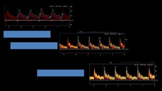 88
CARÓTIDA COMÚN
CARÓTIDA INTERNA
CARÓTIDA EXTERNA
 