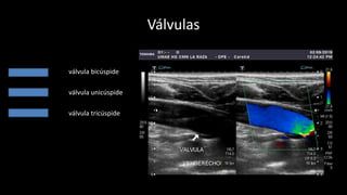 Válvulas
77 - 98% válvula bicúspide
1.4 – 1.6 % válvula unicúspide
0 - 7% válvula tricúspide
98
 
