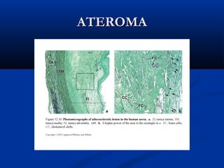 ATEROMA

 