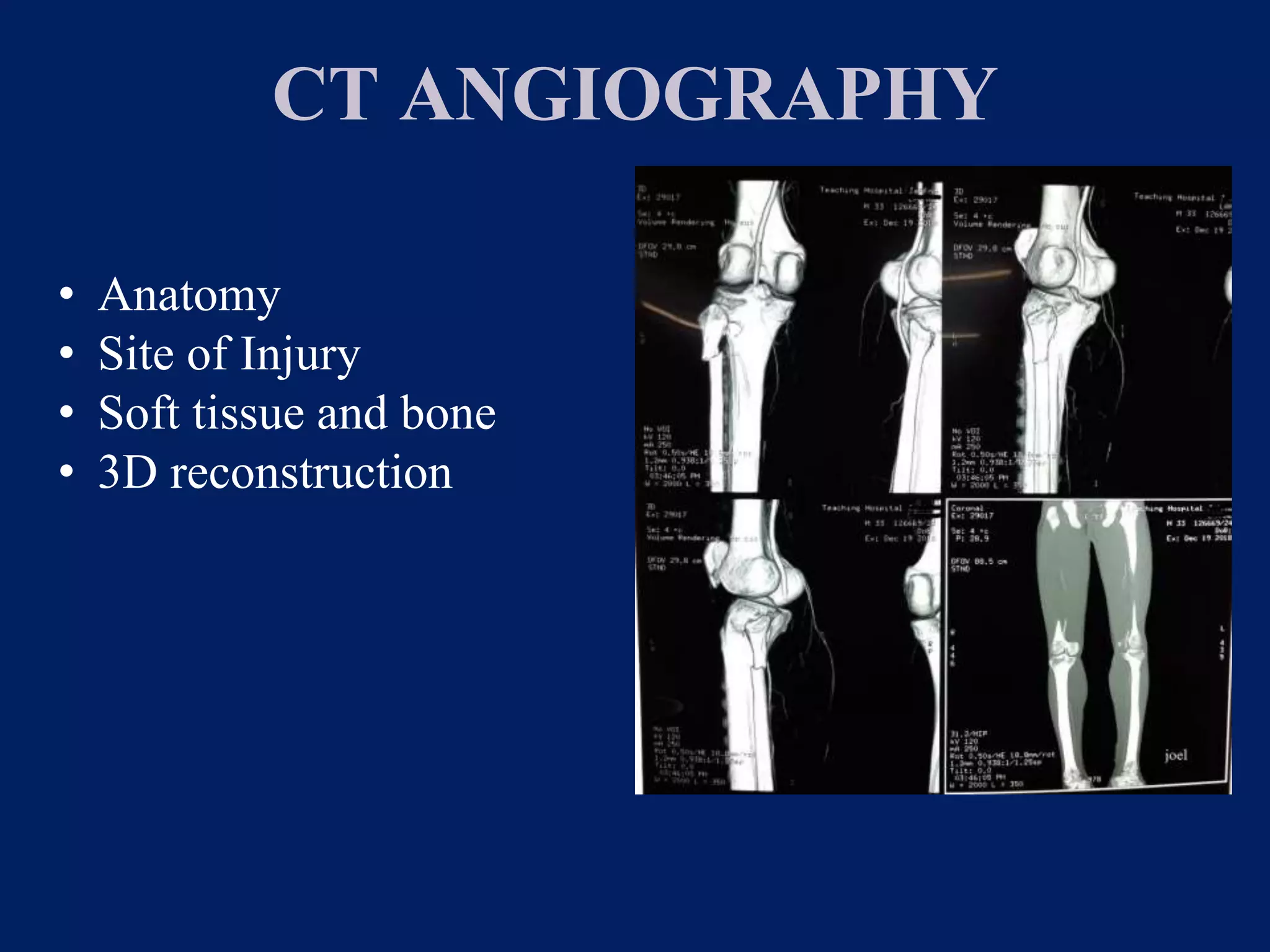 CT ANGIOGRAPHY
• Anatomy
• Site of Injury
• Soft tissue and bone
• 3D reconstruction
 