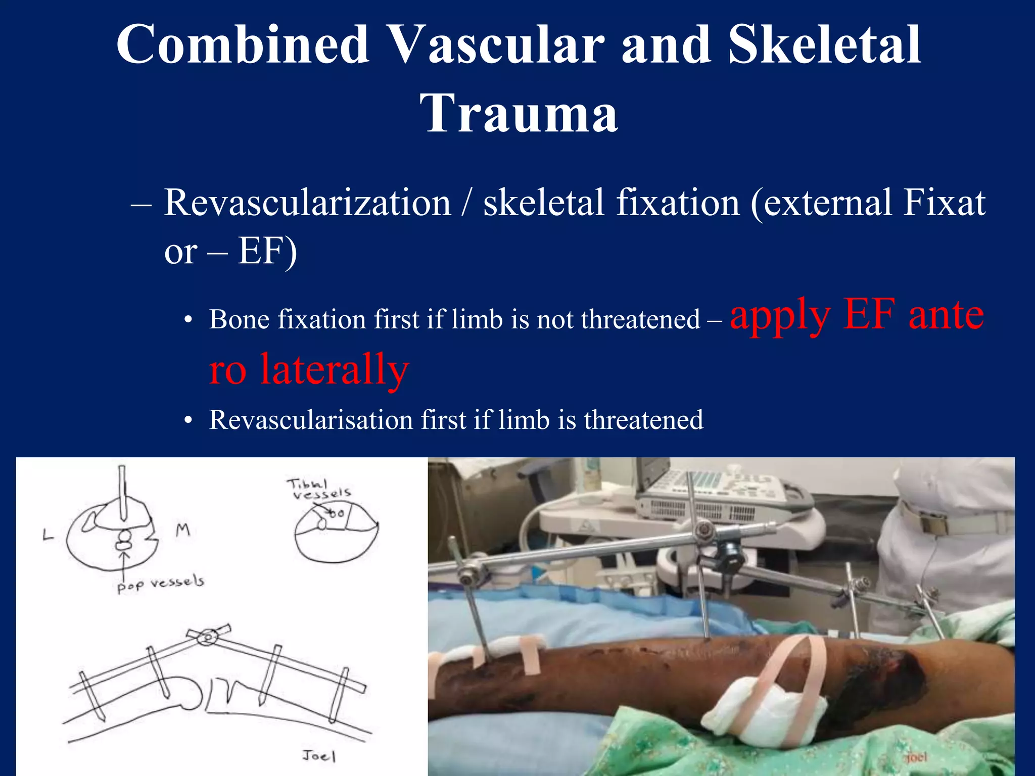 Combined Vascular and Skeletal
Trauma
– Revascularization / skeletal fixation (external Fixat
or – EF)
• Bone fixation first if limb is not threatened – apply EF ante
ro laterally
• Revascularisation first if limb is threatened
 