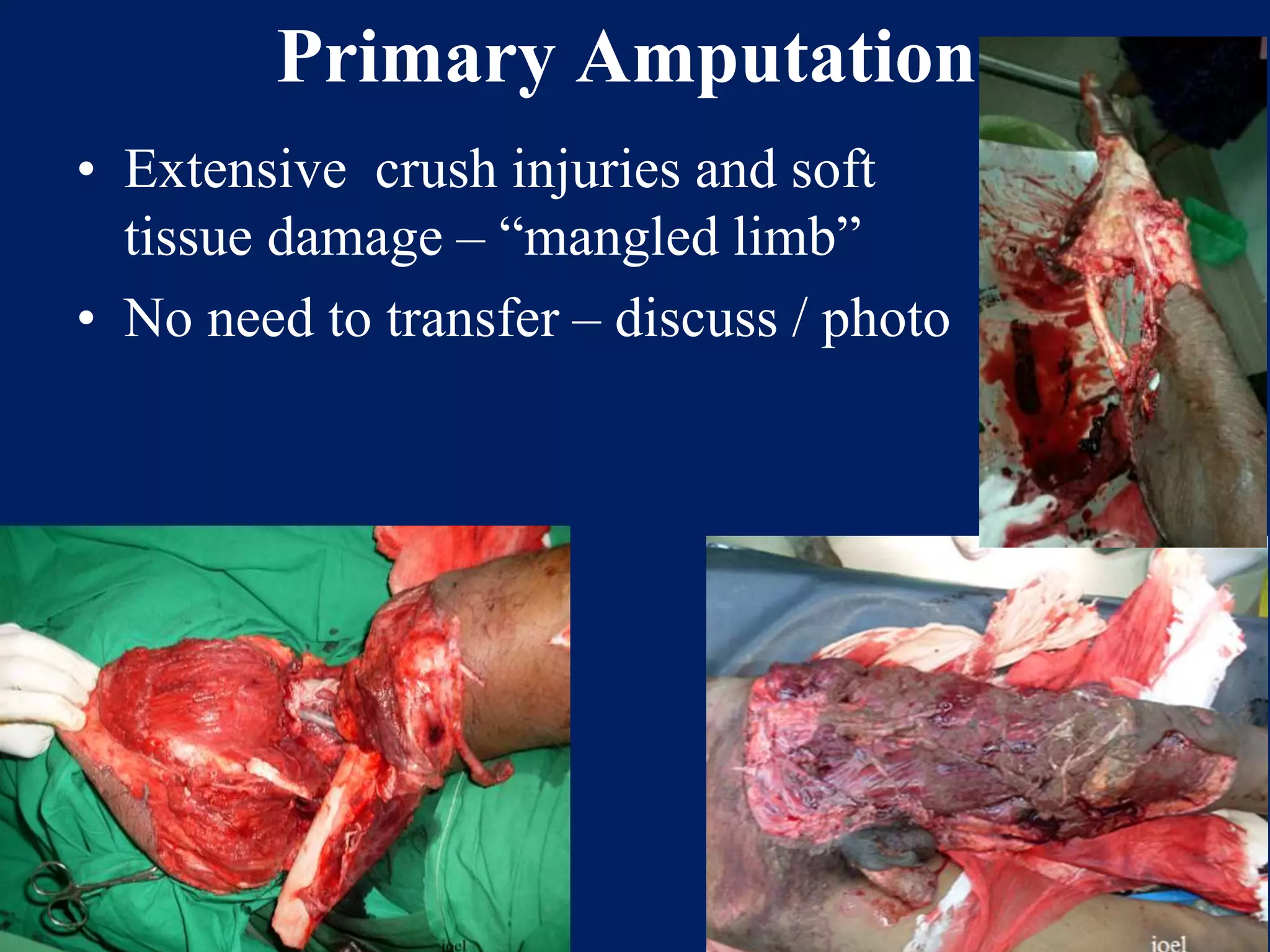 Primary Amputation
• Extensive crush injuries and soft
tissue damage – “mangled limb”
• No need to transfer – discuss / photo
 