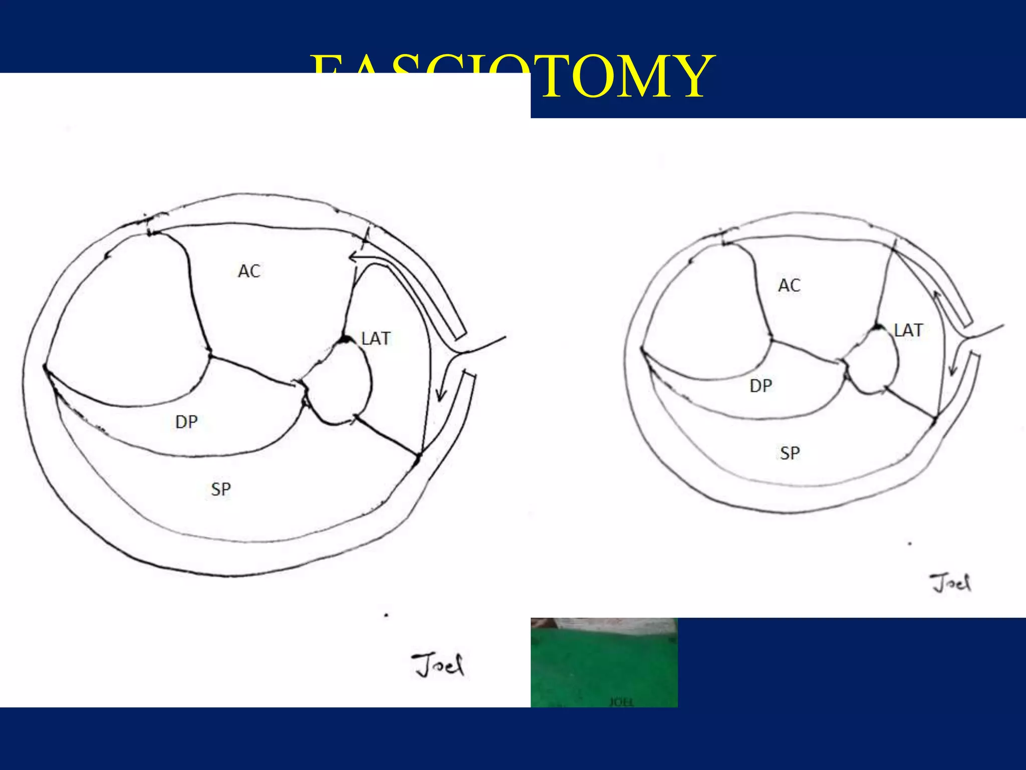 FASCIOTOMY
 