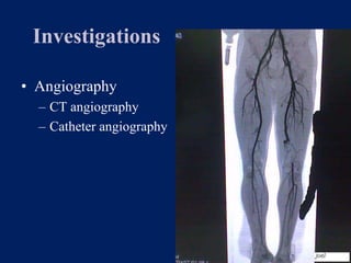 Investigations
• Angiography
– CT angiography
– Catheter angiography
 