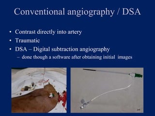 Conventional angiography / DSA
• Contrast directly into artery
• Traumatic
• DSA – Digital subtraction angiography
– done though a software after obtaining initial images
 