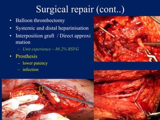Surgical repair (cont..)
• Balloon thrombectomy
• Systemic and distal heparinisation
• Interposition graft / Direct approxi
mation
– Unit experience – 88.2% RSVG
• Prosthesis
– lower patency
– infection
 
