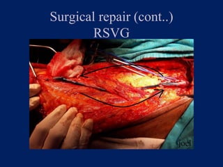 Surgical repair (cont..)
RSVG
 