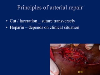 Principles of arterial repair
• Cut / laceration _ suture transversely
• Heparin – depends on clinical situation
 