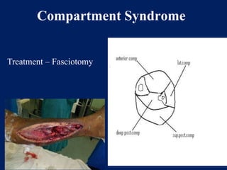 Compartment Syndrome
Treatment – Fasciotomy
 