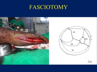 FASCIOTOMY
 