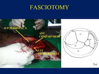 FASCIOTOMY
 