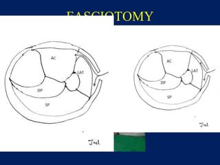 FASCIOTOMY
 