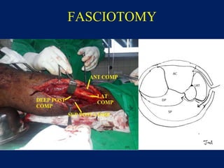 FASCIOTOMY
 