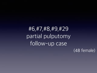  
#6,#7,#8,#9,#29
partial pulputomy
follow-up case
(48 female)
 