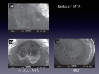 Endocem MTA
ProRoot MTA IRM
 