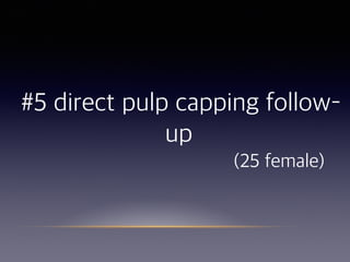 #5 direct pulp capping follow–
up 
(25 female)
 
