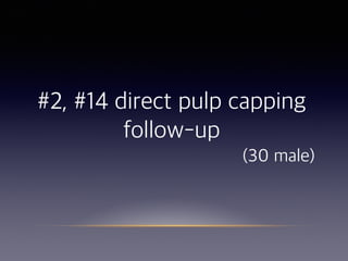 #2, #14 direct pulp capping
follow-up  
(30 male)
 