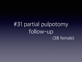 #31 partial pulpotomy
follow-up  
(38 female)
 