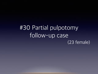 #30 Partial pulpotomy
follow-up case  
(23 female) 
 