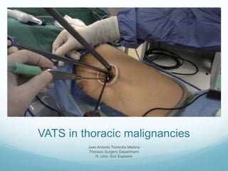VATS in thoracic malignancies
Juan Antonio Torrecilla Medina
Thoracic Surgery Department
H. Univ. Son Espases
 