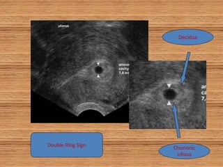 Chorionic Ring Obstetrics_Ultrasound_FMS_2019_DR_RAFAIE_AMIN.pdf