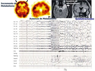 Ausencia de
Incremento de                             reforzamiento
Metabolismo




                Ausencia de Metabolismo            QuisteAracnoideo
 