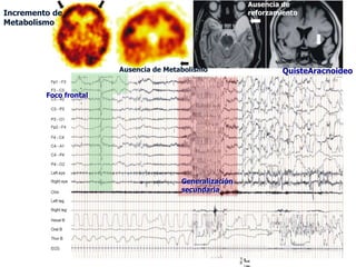 Ausencia de
Incremento de                                            reforzamiento
Metabolismo




                        Ausencia de Metabolismo                   QuisteAracnoideo


         Foco frontal




                                        Generalización
                                        secundaria
 