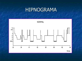 HIPNOGRAMA
 