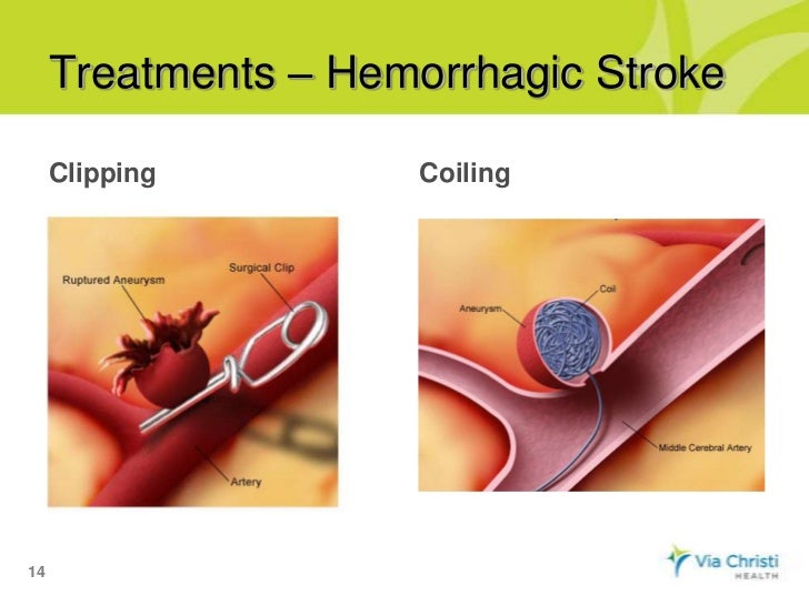 stroke treatment via christi s connection what is stroke stroke treatment via christi s connection what is stroke